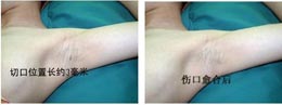 腋臭技术改良小切口汗腺清除术前后对比.GIF