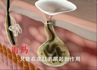 药物无法治疗狐臭.JPG