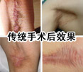 传统手术治疗效果图.jpg